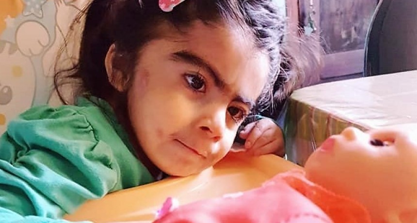 La ni&ntilde;a que naci&oacute; con s&iacute;ndrome de Cornelia de Lange.