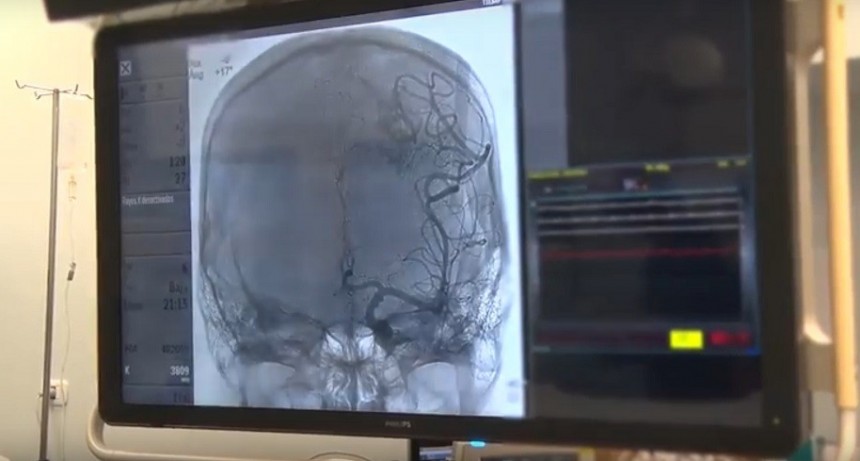 Hospital Regional. Comenzaron a tratarse los aneurismas cerebrales por vía endovascular